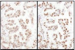 Immunohistochemistry-Paraffin: SFRS4 Antibody [NBP2-04144] - Sections of human lung carcinoma.