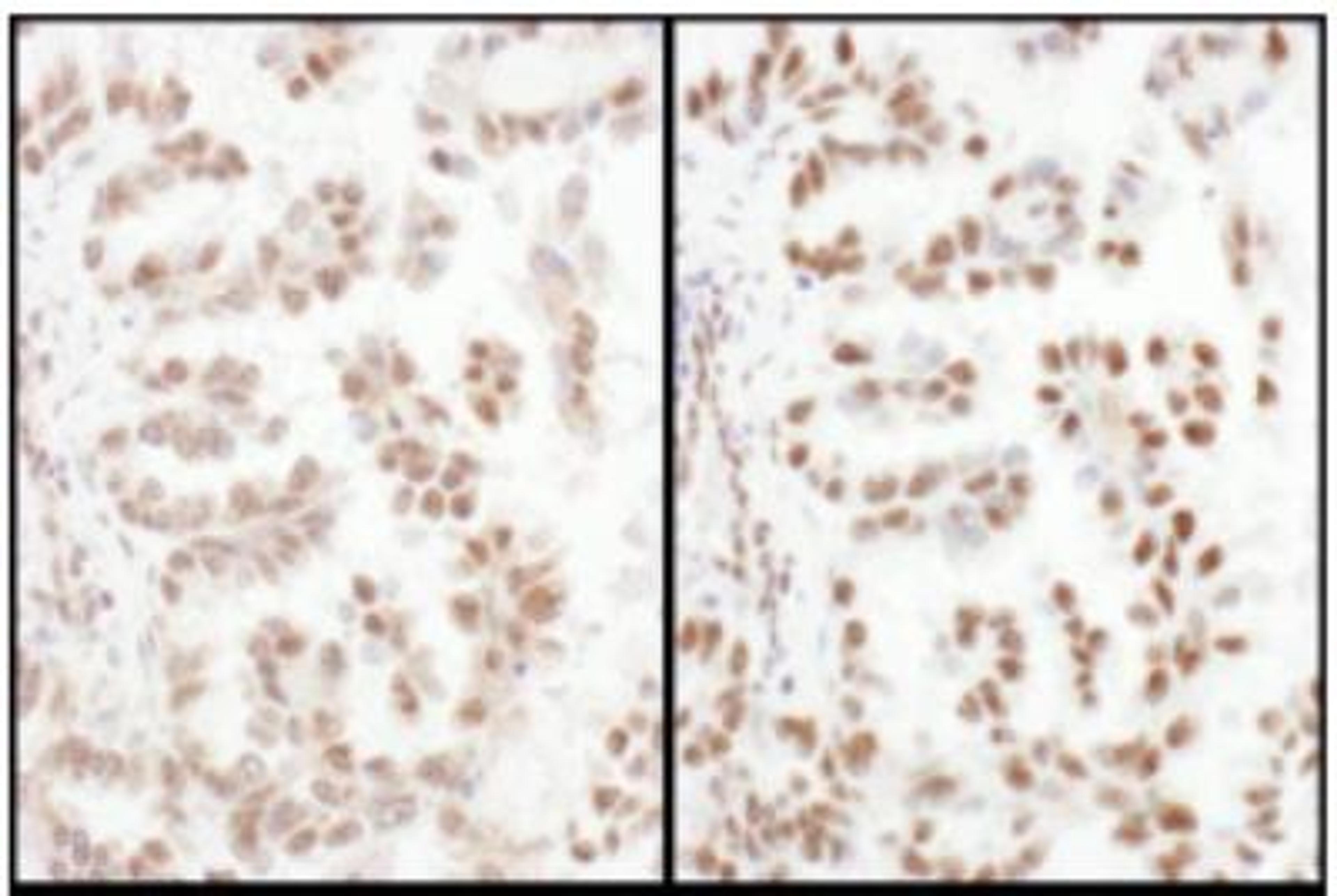 Immunohistochemistry-Paraffin: SFRS4 Antibody [NBP2-04144] - Sections of human lung carcinoma.