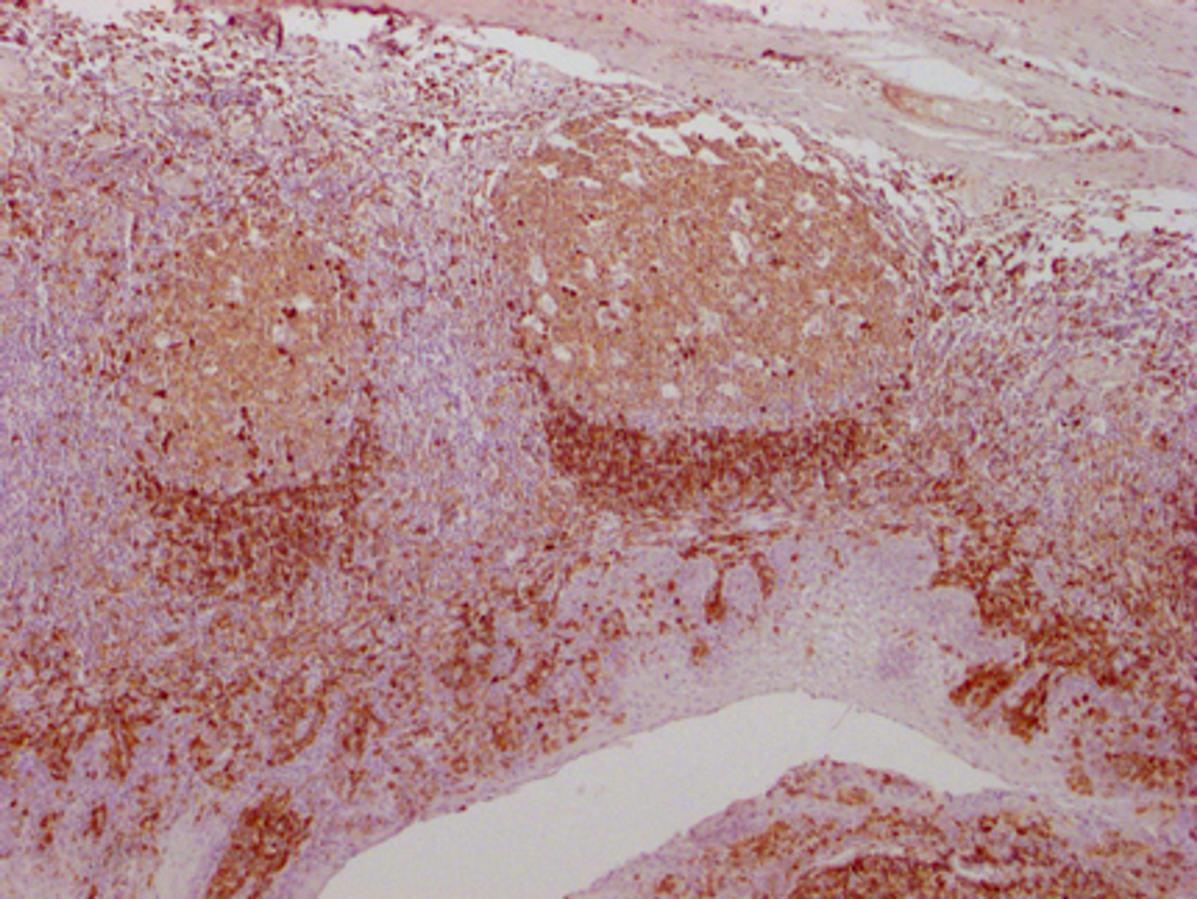 IHC image of CSB-MA961575 diluted at 1:100 and staining in paraffin-embedded human tonsil tissue performed on a Leica BondTM system. After dewaxing and hydration, antigen retrieval was mediated by high pressure in a citrate buffer (pH 6.0). Section was blocked with 10% normal goat serum 30min at RT. Then primary antibody (1% BSA) was incubated at 4°C overnight. The primary is detected by a Goat anti-mouse IgG polymer labeled by HRP and visualized using 0.05% DAB.