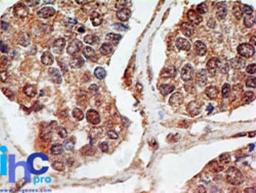 Immunohistochemistry-Paraffin: p73 Antibody (5B429) [NBP2-24737] - Formalin-fixed, paraffin-embedded breast cancer probed with p73 antibody at 5 ug/ml. Human tissue was used for this test.    Staining of formalin-fixed tissues is enhanced by boiling tissue sections in 10 mM sodium citrate buffer, pH 6.0 for 10-20 min followed by cooling at RT for 20 min.