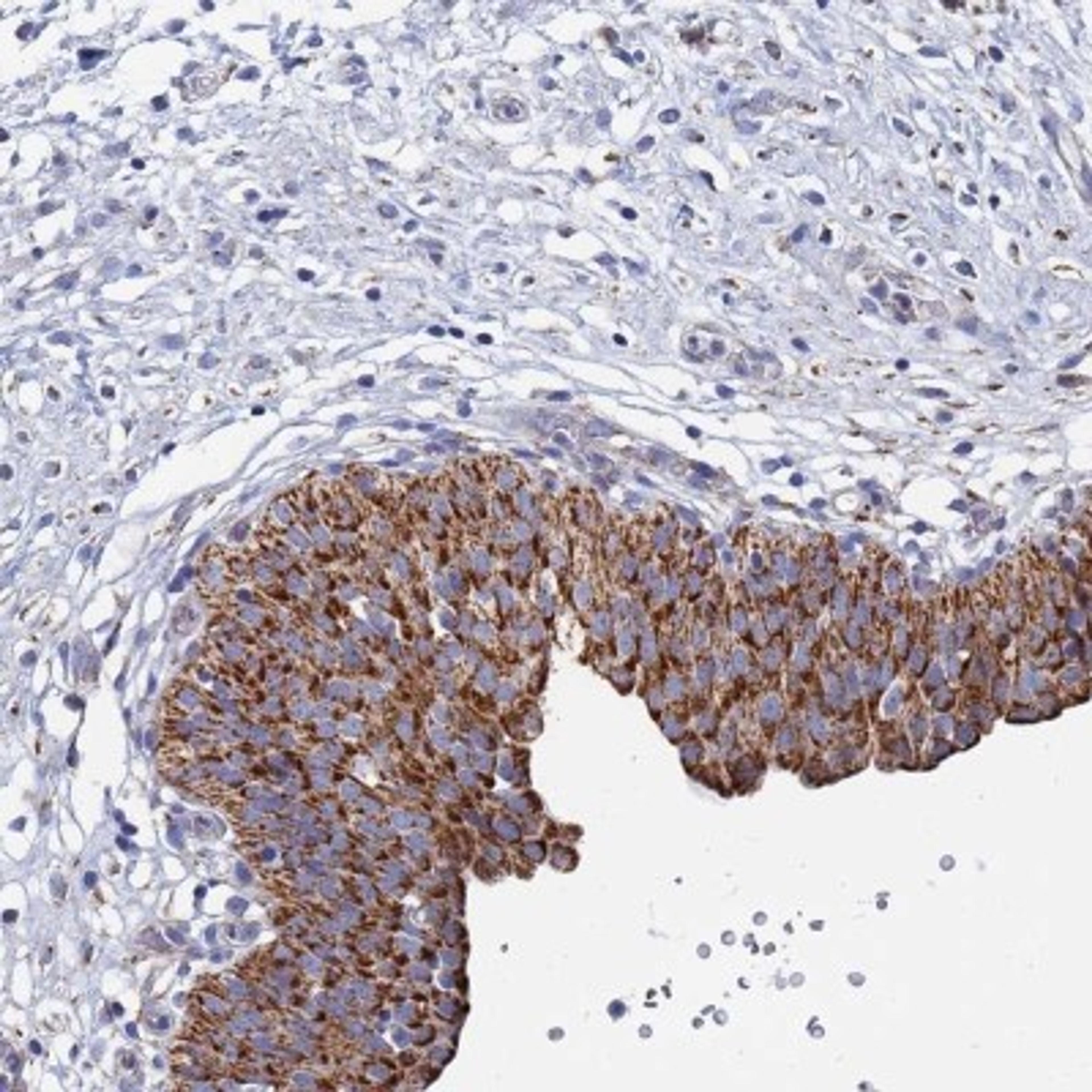 Immunohistochemistry: ANKRD34C Antibody [NBP2-33442] - Immunohistochemical staining of human urinary bladder shows strong granular cytoplasmic positivity in urothelial cells.