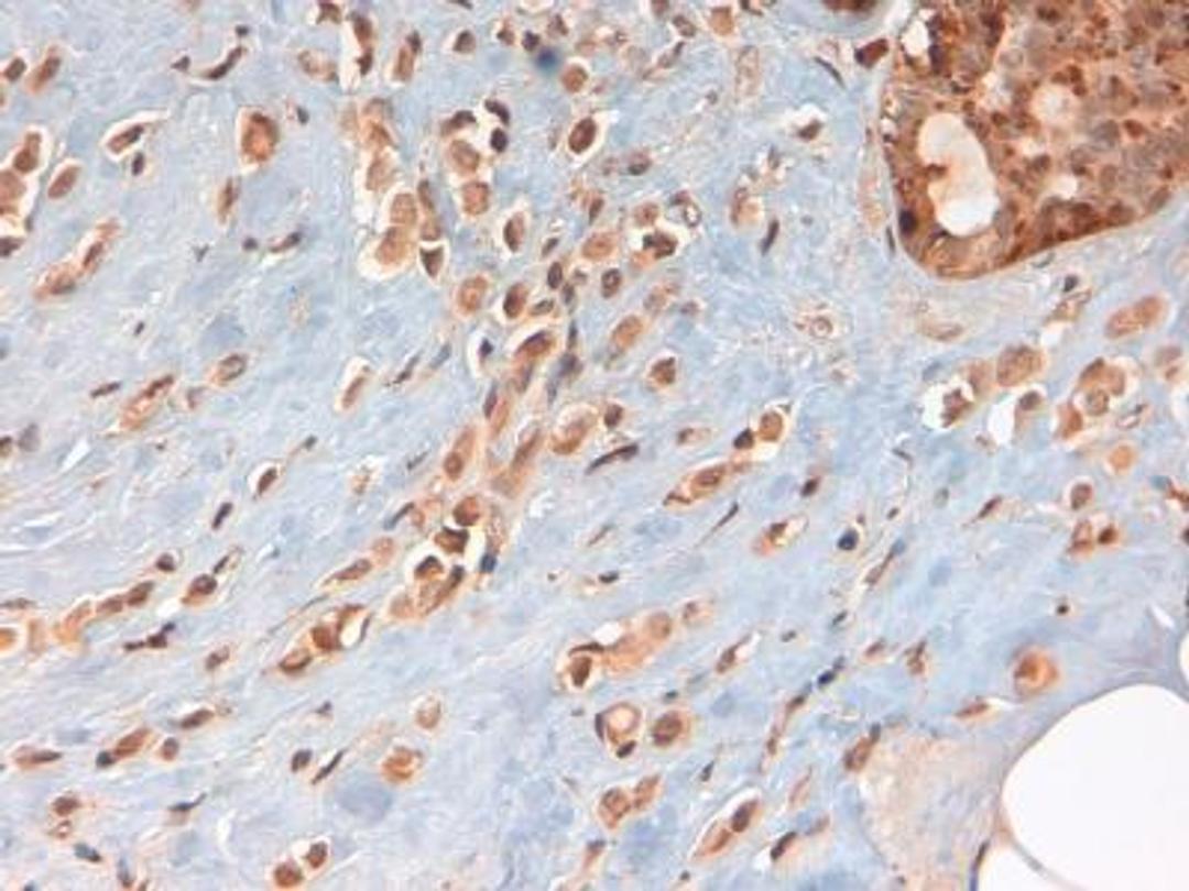 Immunohistochemistry-Paraffin: PKM1 Antibody [NBP2-14833] - PKM1 antibody was tested in human breast cancer using DAB with hematoxylin counterstain.