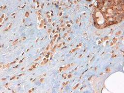 Immunohistochemistry-Paraffin: PKM1 Antibody [NBP2-14833] - PKM1 antibody was tested in human breast cancer using DAB with hematoxylin counterstain.