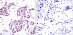 Immunohistochemistry: STAT6 [p Tyr641] Antibody [NB100-2138] - IHC analysis of paraffin-embedded breast ca. Left: Stained with STAT6 (Tyr641) (NB100-2138) Right: Same antibody pre-incubated with synthetic phospho-peptide.