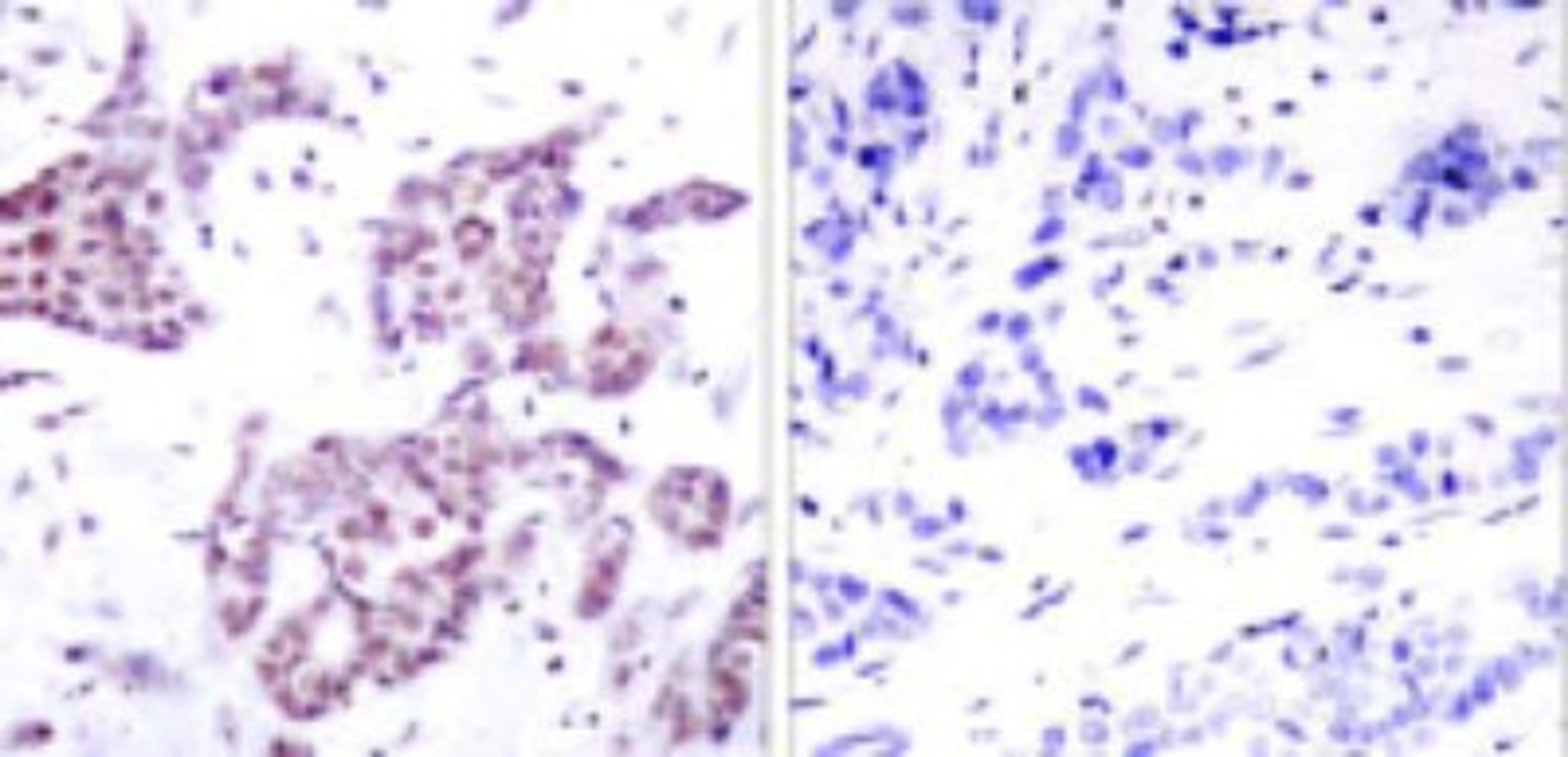 Immunohistochemistry: STAT6 [p Tyr641] Antibody [NB100-2138] - IHC analysis of paraffin-embedded breast ca. Left: Stained with STAT6 (Tyr641) (NB100-2138) Right: Same antibody pre-incubated with synthetic phospho-peptide.