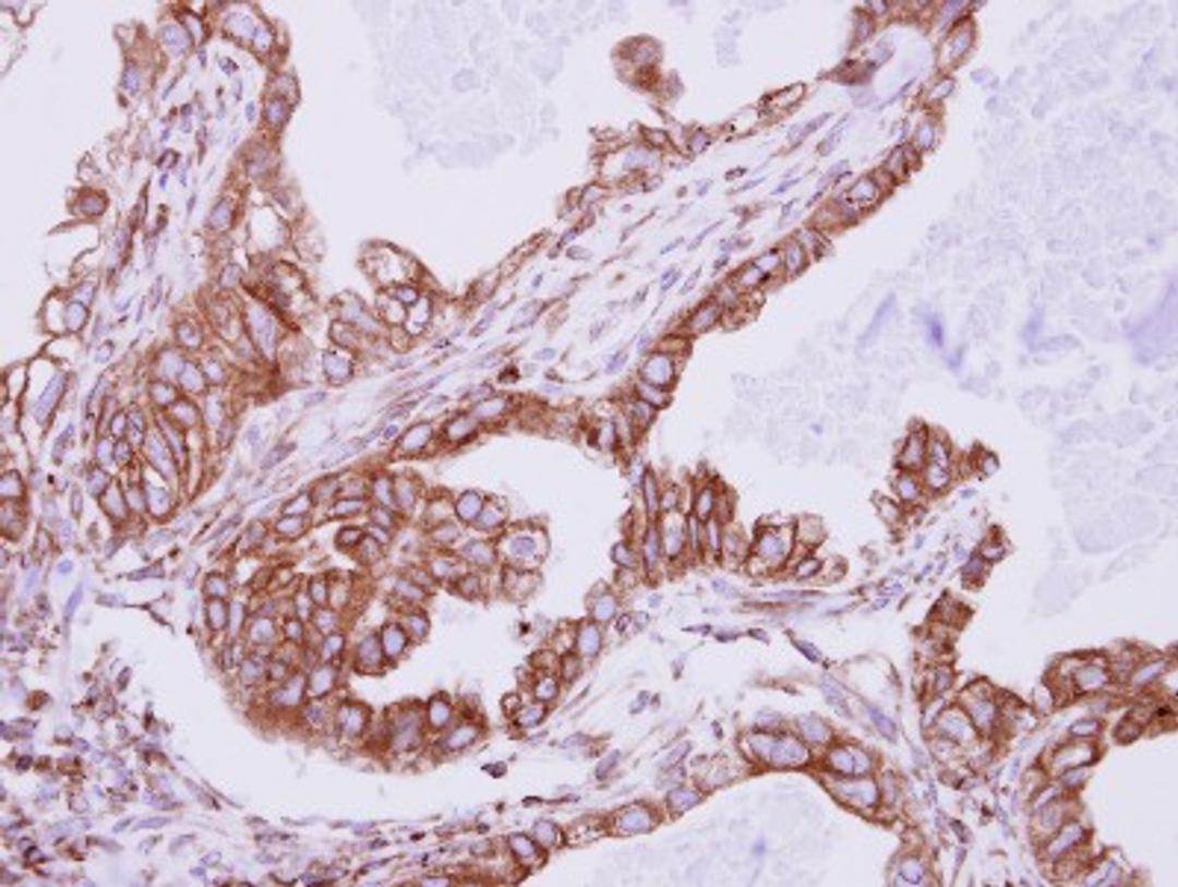 Immunohistochemistry-Paraffin: Ift80 Antibody [NBP2-16927] - Immunohistochemical analysis of paraffin-embedded AdCA, using antibody at 1:500 dilution.