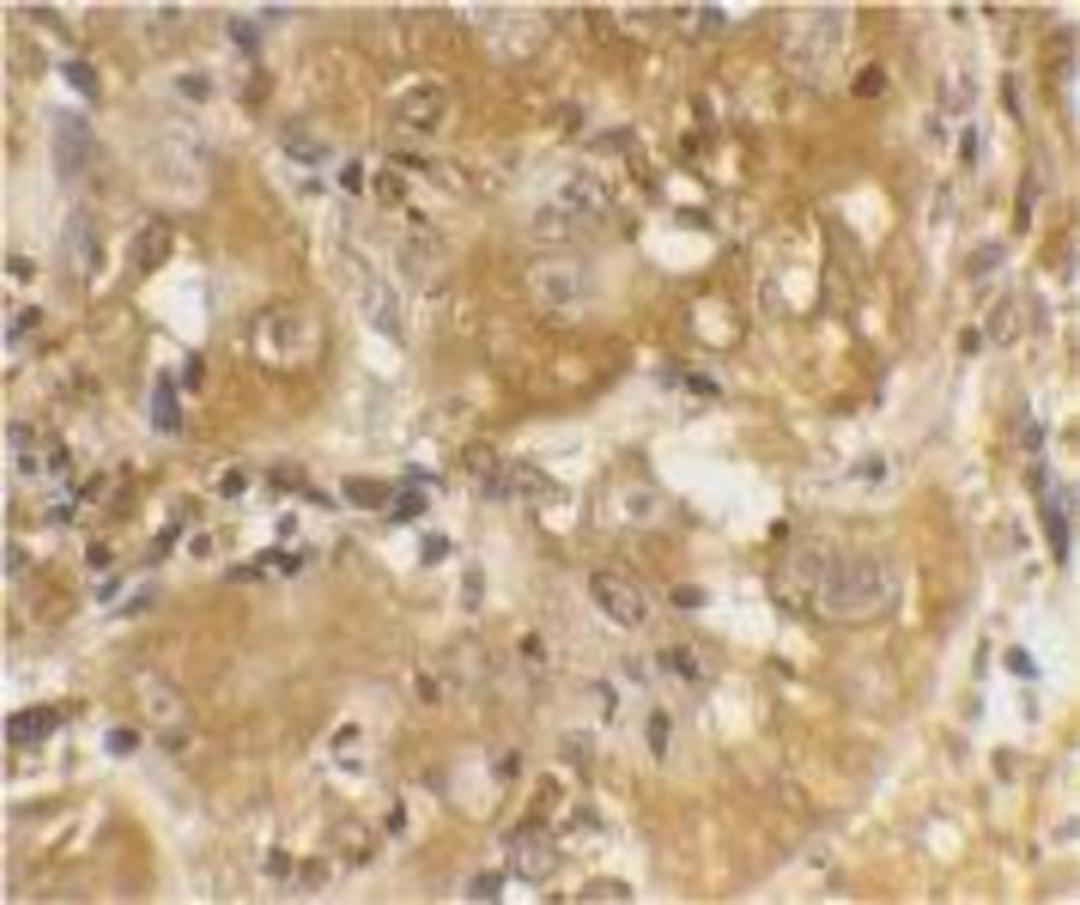 Immunohistochemistry-Paraffin: Bim Antibody [NBP1-76963] - Human skin cancer cells with Bim antibody at 20 ug/ml.