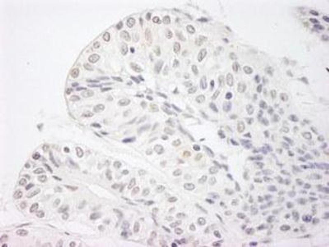 Immunohistochemistry-Paraffin: Jarid1A Antibody [NB110-40499] - FFPE section of human prostate carcinoma. Affinity purified rabbit anti-JARID1A/RBP2 used at a dilution of 1:250. Detection: DAB staining using Immunohistochemistry Accessory Kit. Epitope Retrieval Buffer-High pH was substituted for Epitope Retrieval Buffer-Reduced pH.