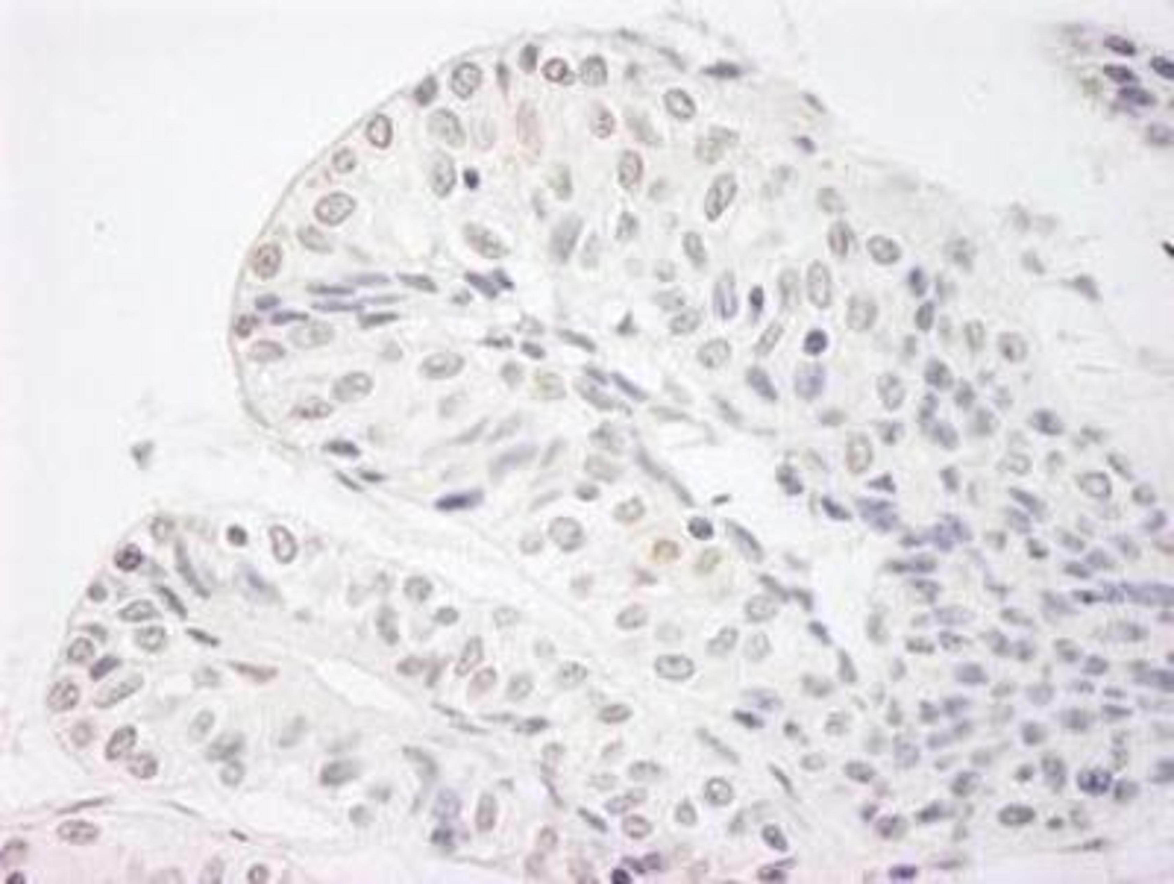 Immunohistochemistry-Paraffin: Jarid1A Antibody [NB110-40499] - FFPE section of human prostate carcinoma. Affinity purified rabbit anti-JARID1A/RBP2 used at a dilution of 1:250. Detection: DAB staining using Immunohistochemistry Accessory Kit. Epitope Retrieval Buffer-High pH was substituted for Epitope Retrieval Buffer-Reduced pH.