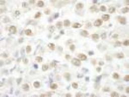 Immunohistochemistry: ARID2 Antibody [NBP1-26615] - FFPE section of human testicular seminoma Antibody used at a dilution of 1:250. Detection: DAB staining using Immunohistochemistry Accessory Kit.