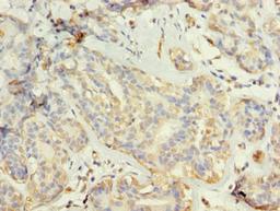 Immunohistochemistry of paraffin-embedded human breast cancer using CSB-PA873636LA01HU at dilution of 1:100