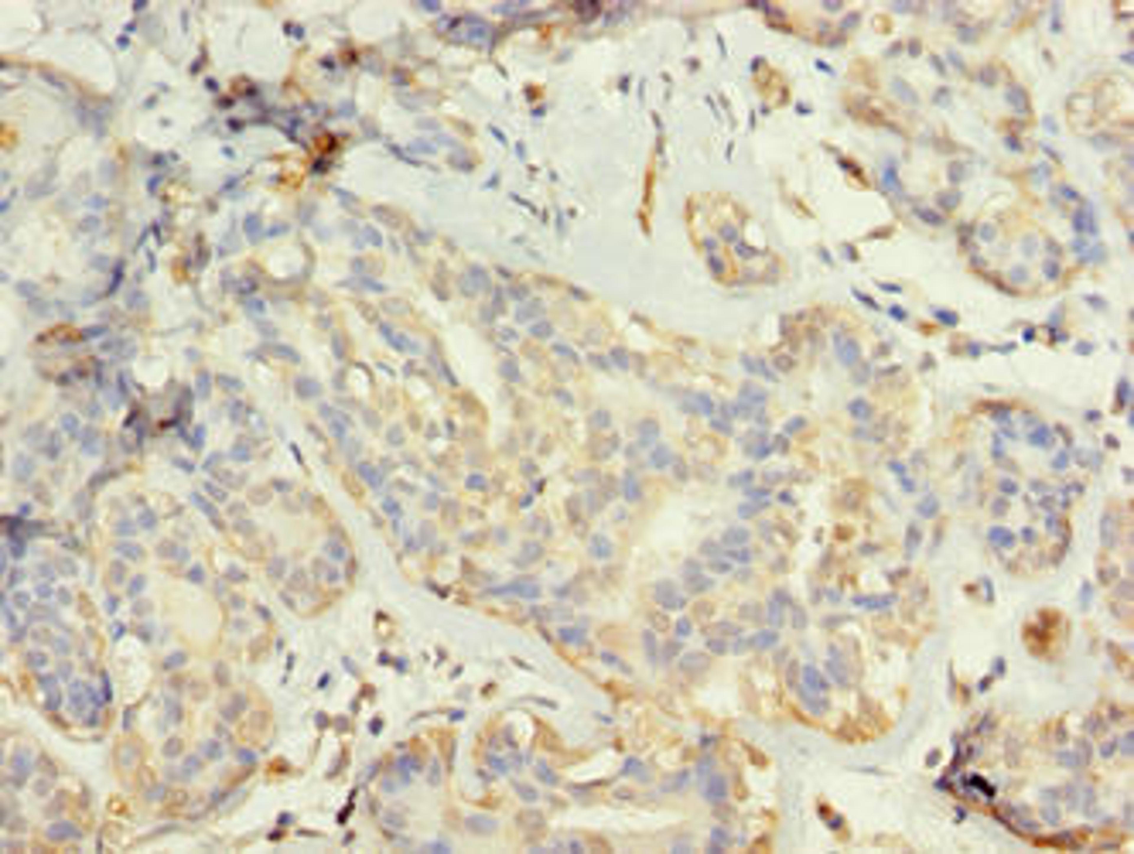 Immunohistochemistry of paraffin-embedded human breast cancer using CSB-PA873636LA01HU at dilution of 1:100