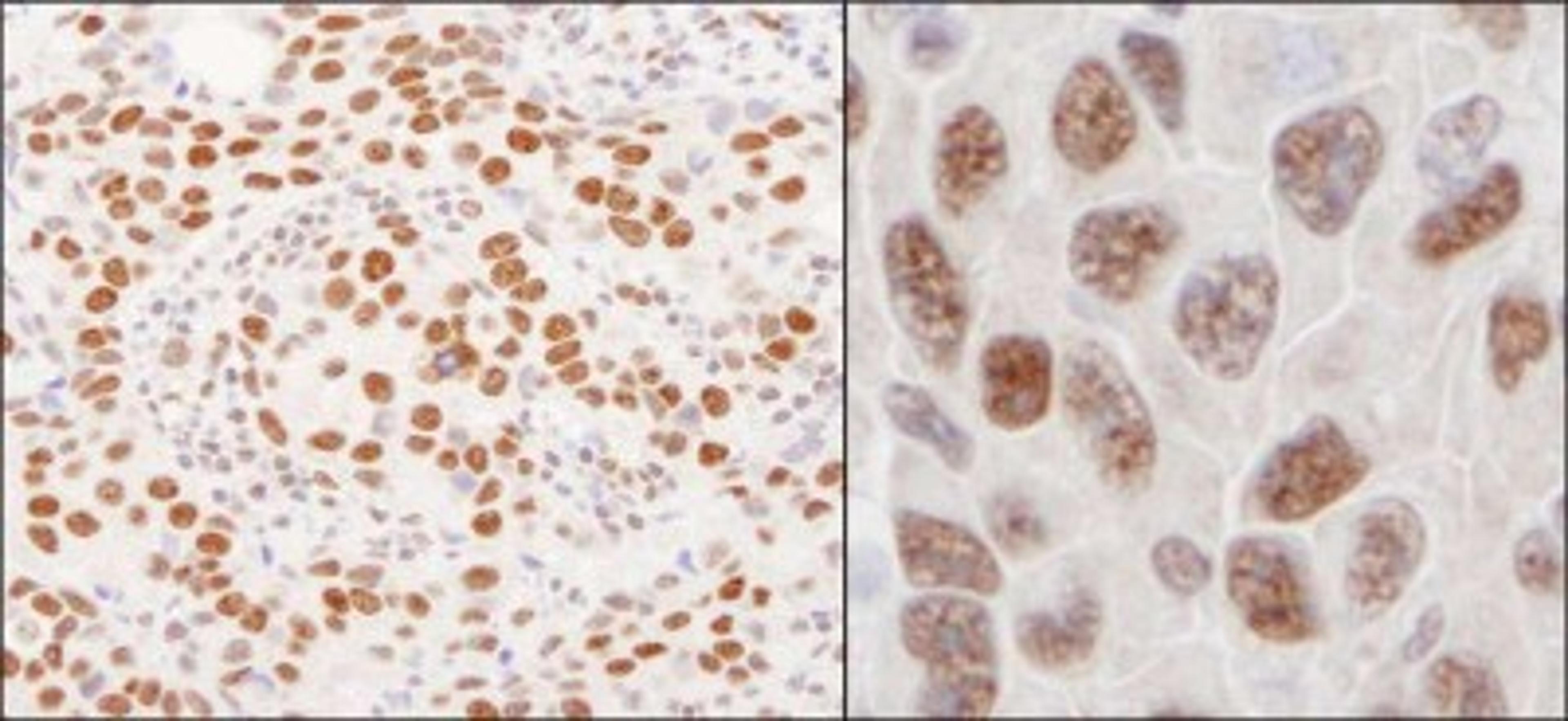 Immunohistochemistry-Paraffin: hnRNP U Antibody [NB100-2134] - Human breast carcinoma (left) and mouse squamous cell carcinoma (right).