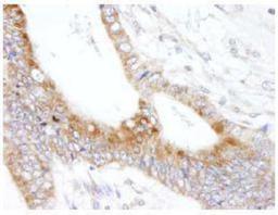 Immunohistochemistry-Paraffin: MAP7 Antibody [NB100-74618] - FFPE section of human colon carcinoma.  Affinity purified rabbit anti-MAP7 used at a dilution of 1:250.