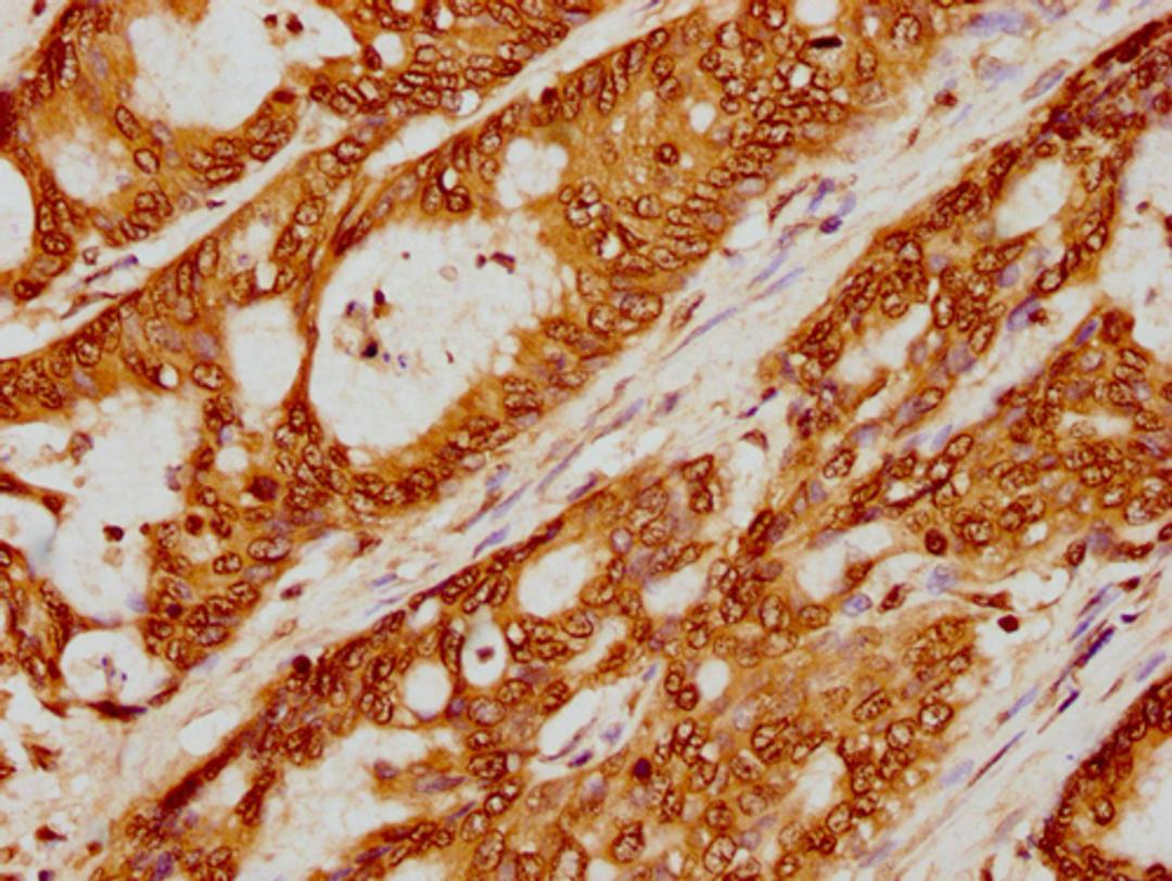 IHC image of CSB-PA010403PA79nme1HU diluted at 1:5 and staining in paraffin-embedded human colon cancer performed on a Leica BondTM system. After dewaxing and hydration, antigen retrieval was mediated by high pressure in a citrate buffer (pH 6.0). Section was blocked with 10% normal goat serum 30min at RT. Then primary antibody (1% BSA) was incubated at 4°C overnight. The primary is detected by a biotinylated secondary antibody and visualized using an HRP conjugated SP system.