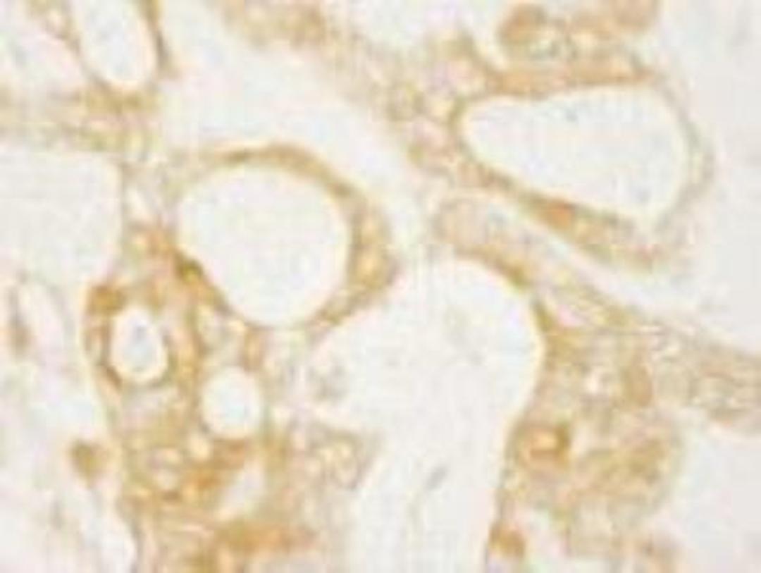 Immunohistochemistry-Paraffin: DIAPH1 Antibody [NB600-231] - FFPE section of human ovarian carcinoma.  Affinity purified rabbit anti-Diaphanous1 used at a dilution of 1:100.