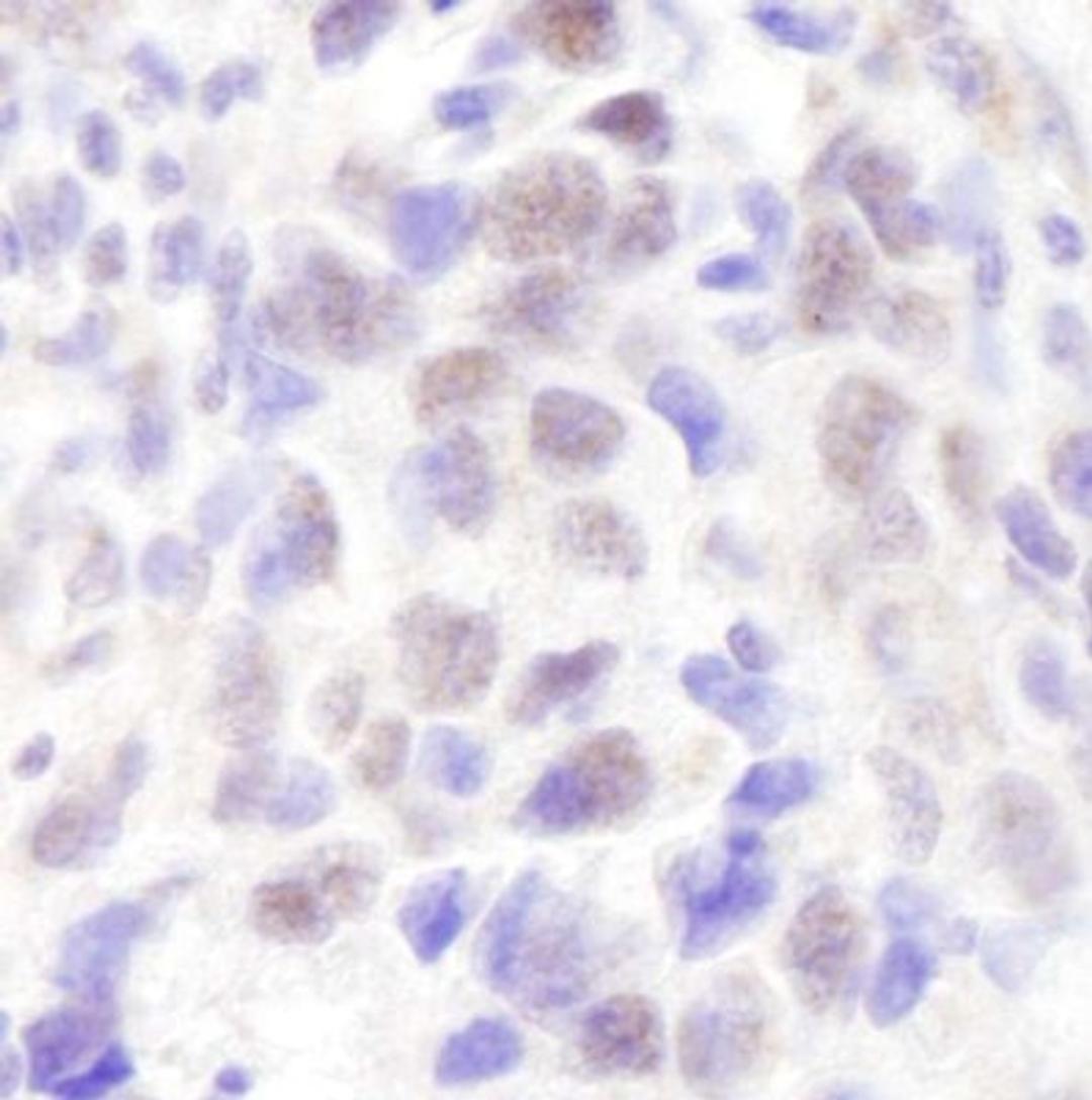 Immunohistochemistry-Paraffin: NCOA6 Antibody [NB200-335] - Human breast carcinoma. Antibody used at a dilution of 1:1000 (1ug/ml).