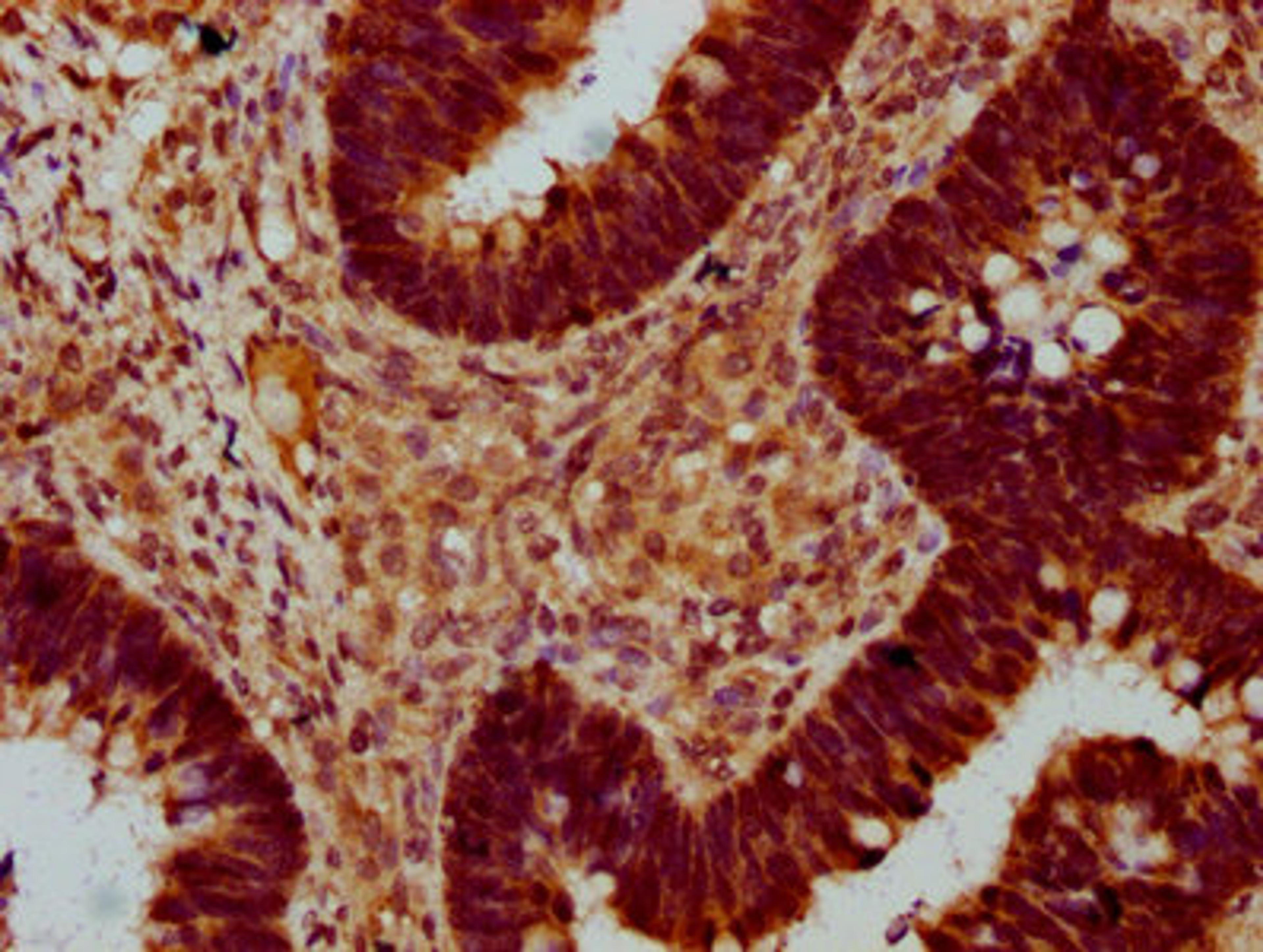 IHC image of CSB-PA022430LA01HU diluted at 1:400 and staining in paraffin-embedded human ovarian cancer performed on a Leica BondTM system. After dewaxing and hydration, antigen retrieval was mediated by high pressure in a citrate buffer (pH 6.0). Section was blocked with 10% normal goat serum 30min at RT. Then primary antibody (1% BSA) was incubated at 4°C overnight. The primary is detected by a biotinylated secondary antibody and visualized using an HRP conjugated SP system.