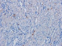 Immunohistochemical staining of human endometrial cancer tissue using PAX6 antibody (dilution of primary antibody - 2.5 ug/ml)