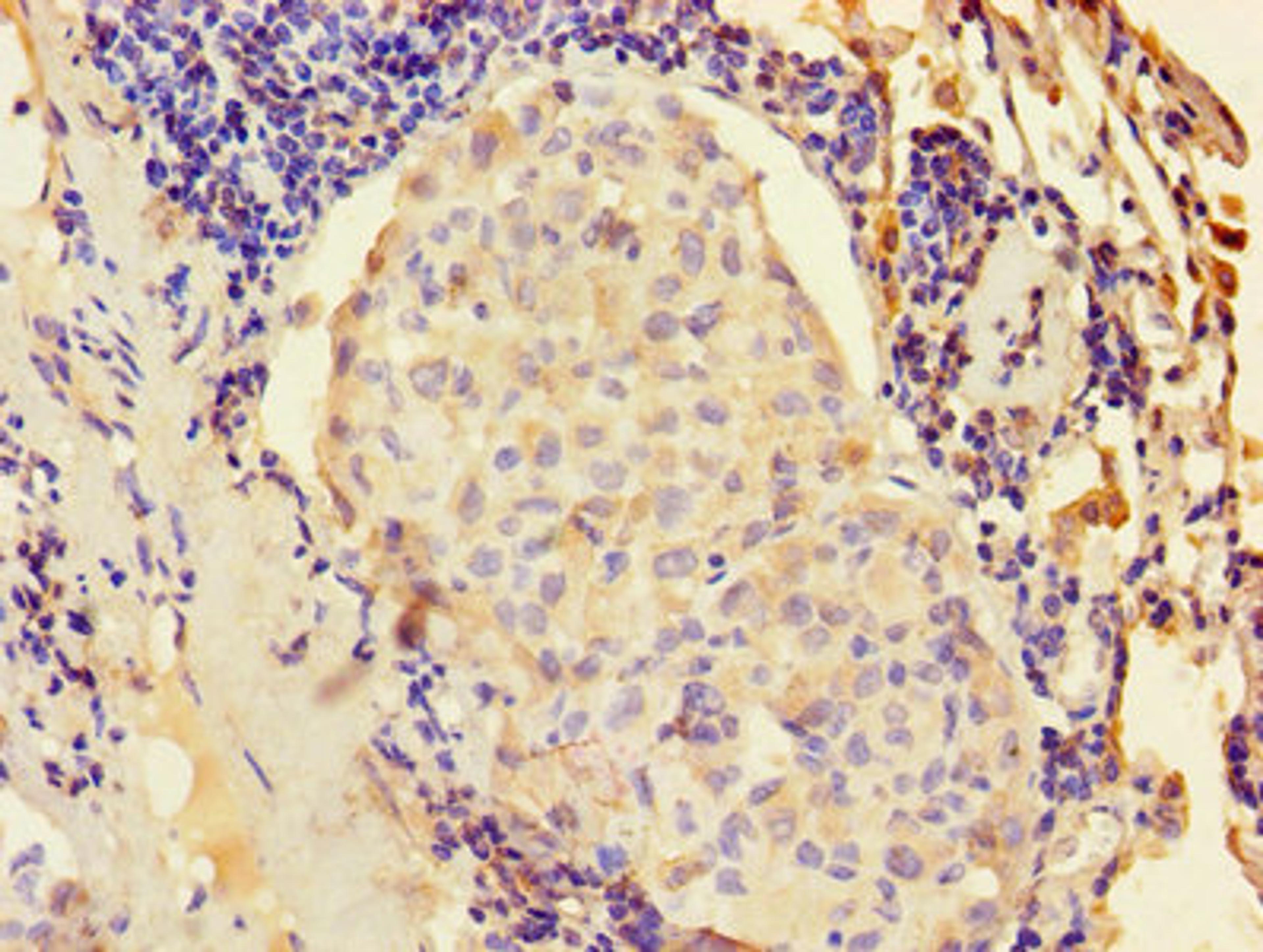 Immunohistochemistry of paraffin-embedded human lung cancer using CSB-PA012561EA01HU at dilution of 1:100