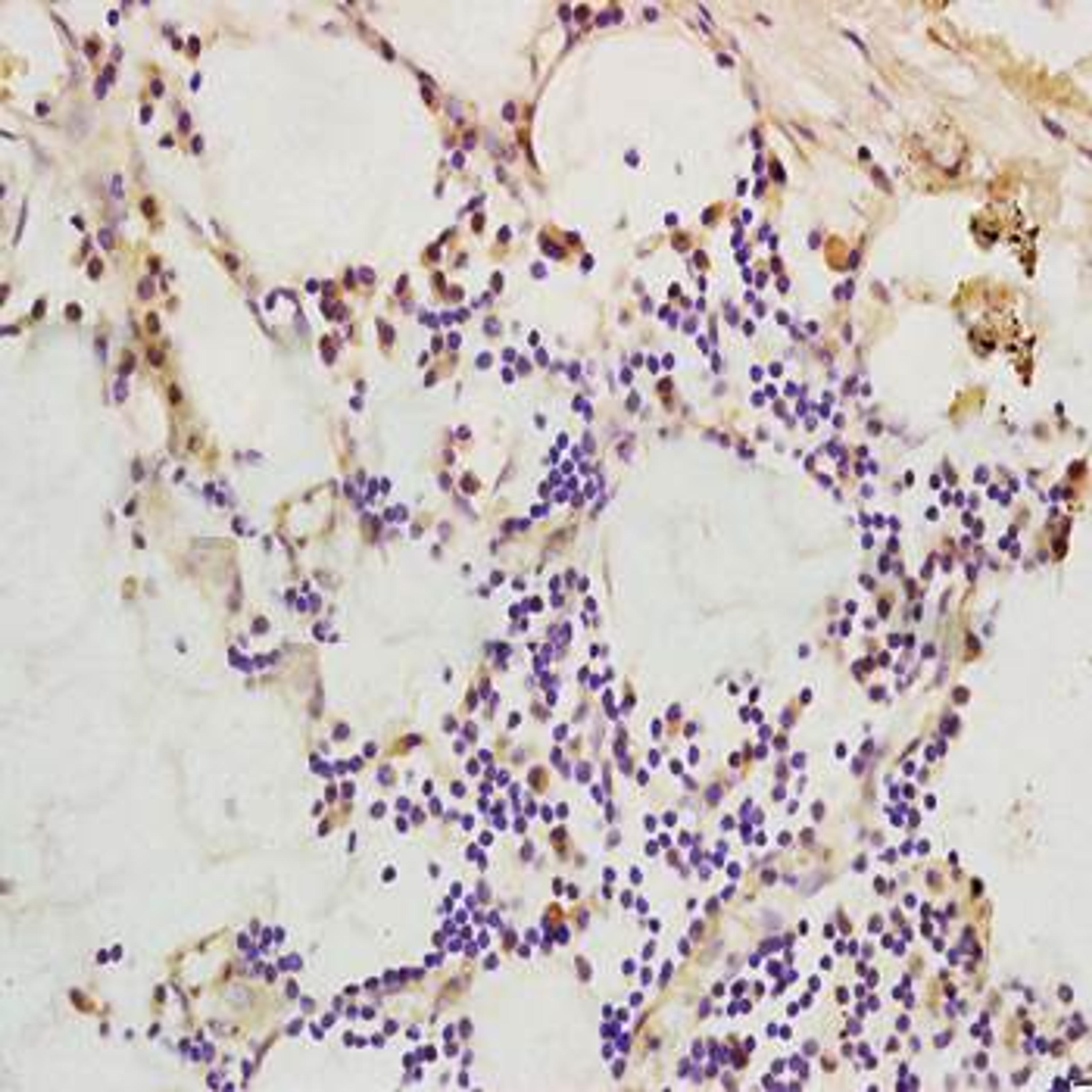 Paraffin-embedded human colon carcinoma fixed with 4% paraformaldehyde. Antigen retrieval by boiling with citrate buffer. Blocking buffer is goat serum (37 degrees for 20 min.). CD99 antibody at 1:200 dilution with overnight incubation at 4 degrees