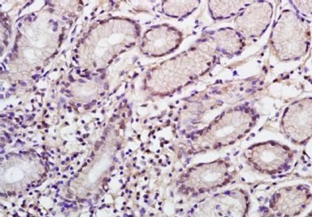 Immunohistochemical analysis of formalin-fixed paraffin embedded human gastric carcinoma tissue using NANOGP8 antibody (dilution at 1:200)