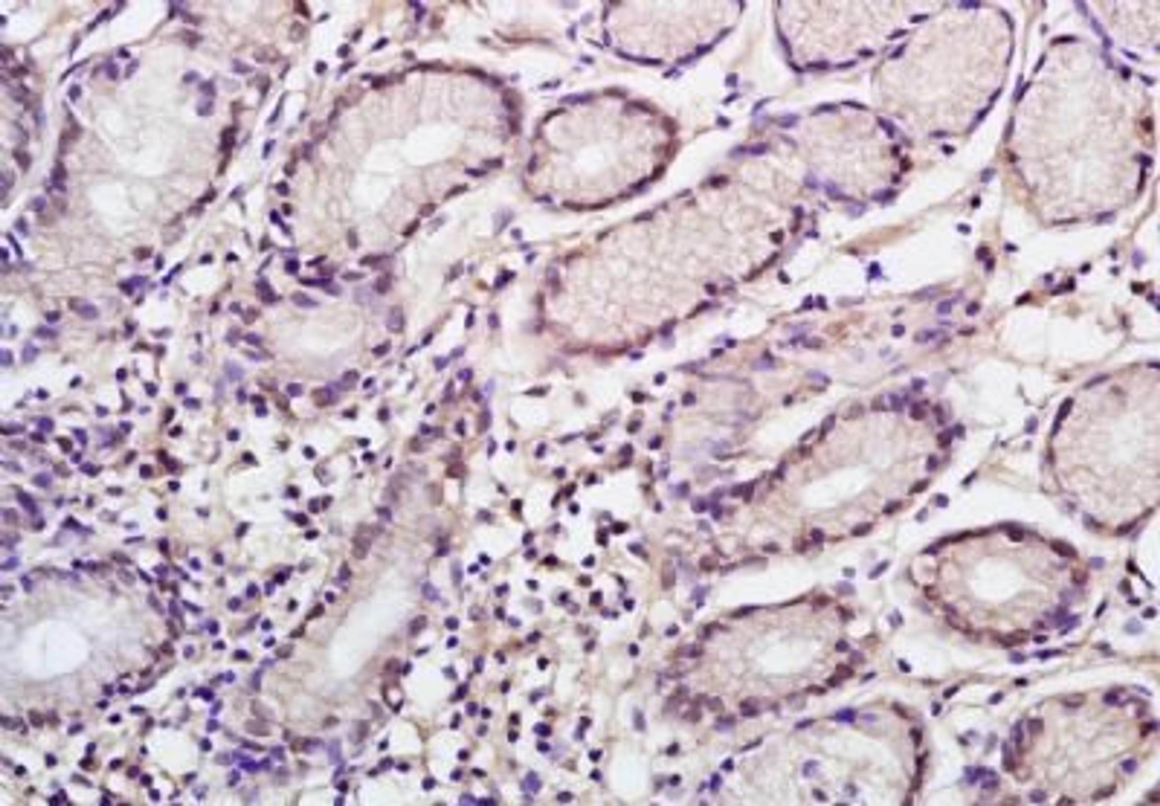 Immunohistochemical analysis of formalin-fixed paraffin embedded human gastric carcinoma tissue using NANOGP8 antibody (dilution at 1:200)