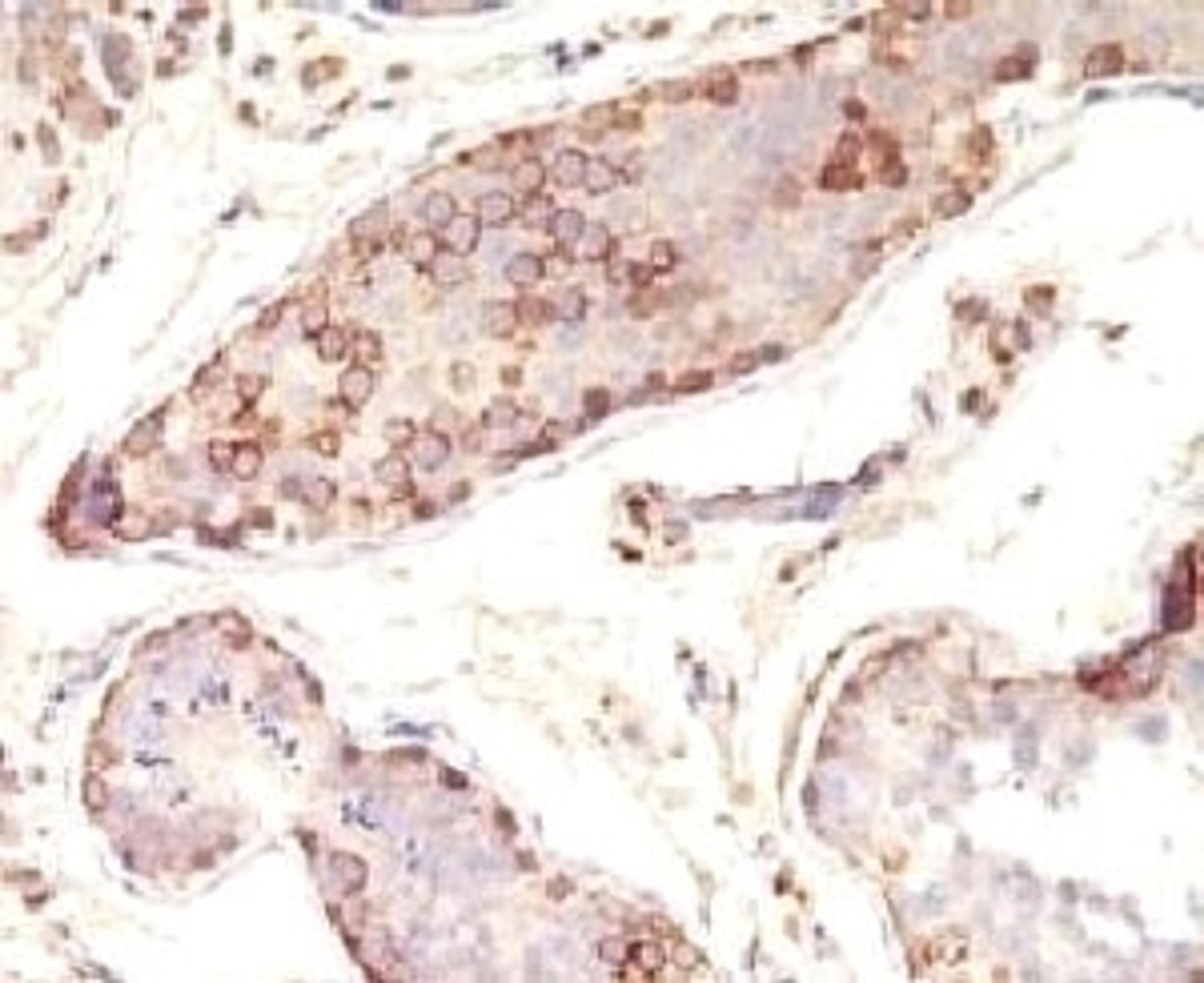 Formalin-fixed, paraffin-embedded human testicular carcinoma stained with MAGE-1 antibody (MZ2E/838).