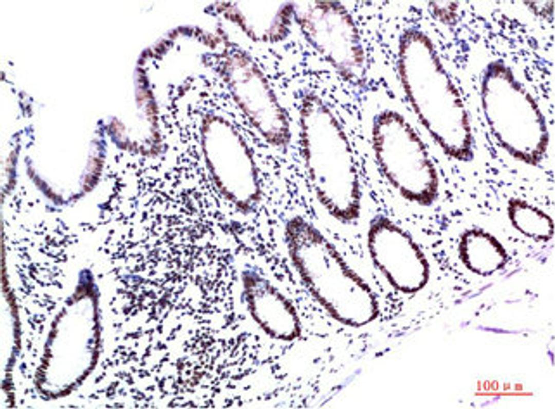 Immunohistochemical analysis of paraffin-embedded Human Colon Carcinoma Tissue using HP-1γ  Mouse mAb diluted at 1:200.