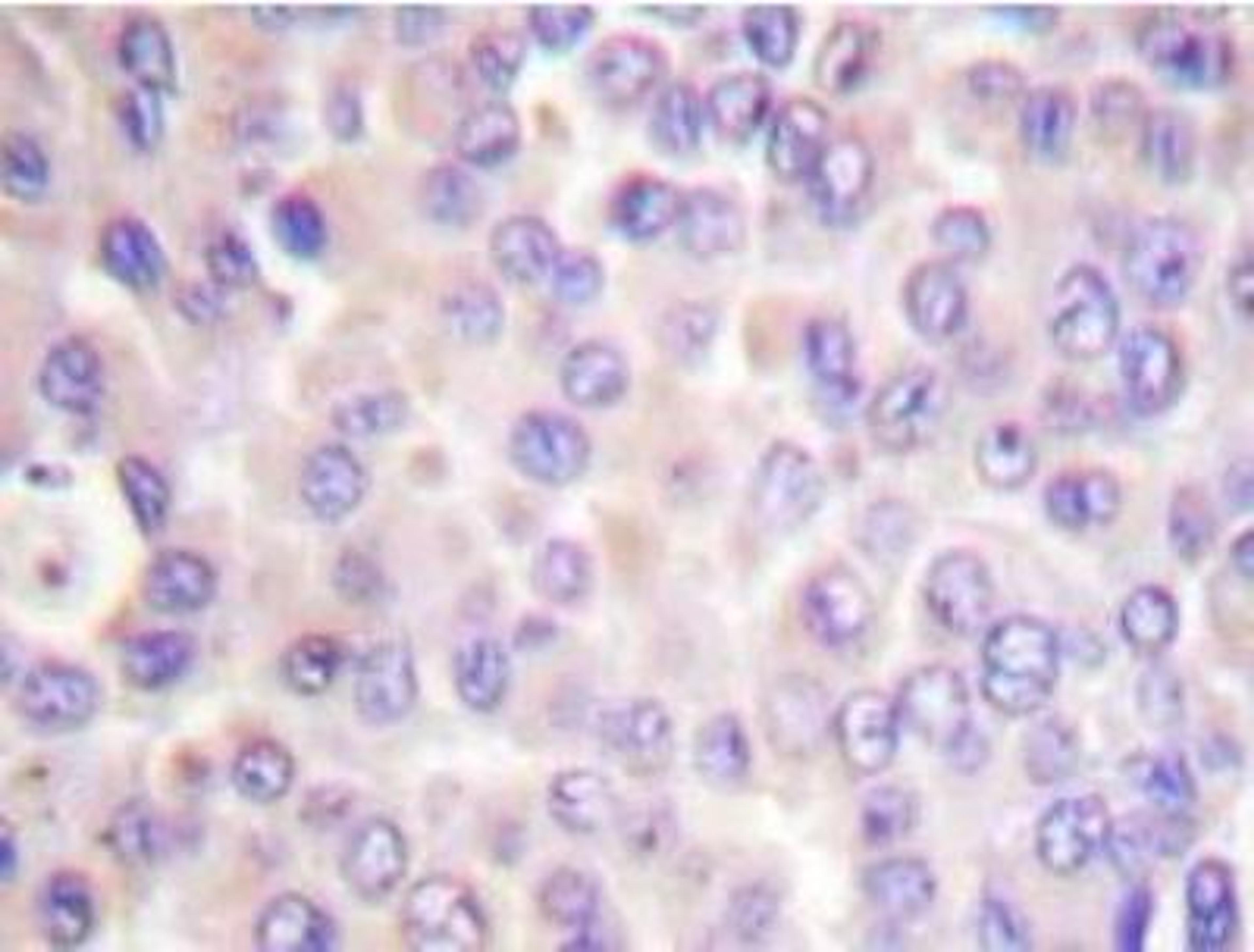 Immunohistochemistry-Paraffin: SYK [p Tyr525] Antibody [NBP1-51392] - NBP1-51392 in paraffin-embedded human breast cancer tissue.