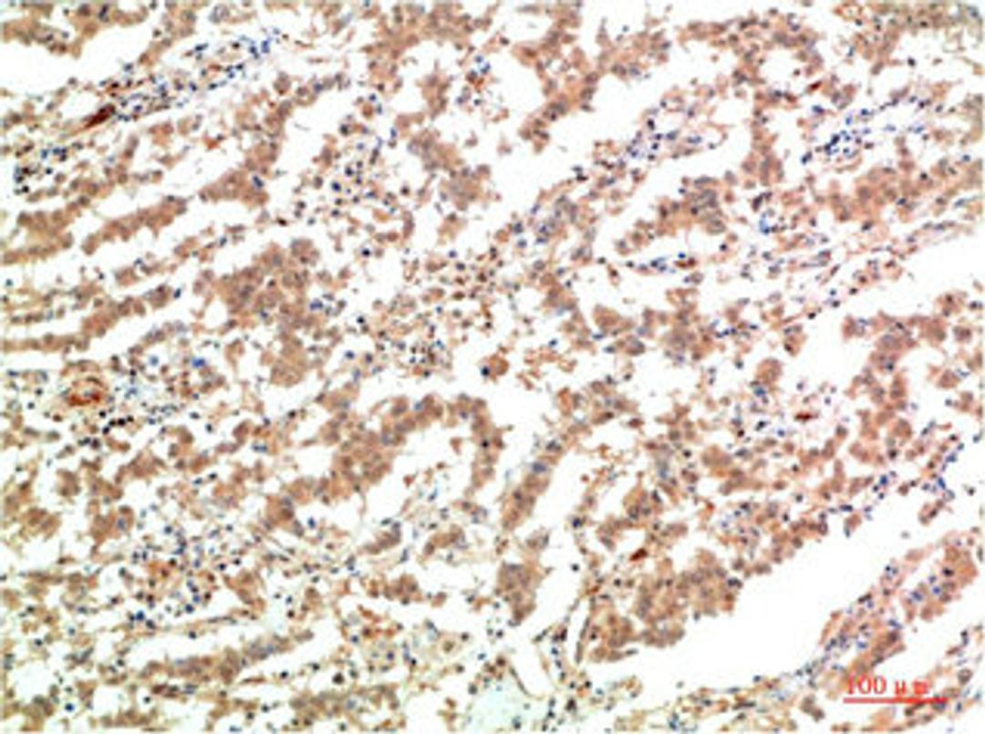 Immunohistochemical analysis of paraffin-embedded Human Lung Carcinoma Tissue using JAK2  Mouse mAb diluted at 1:200.