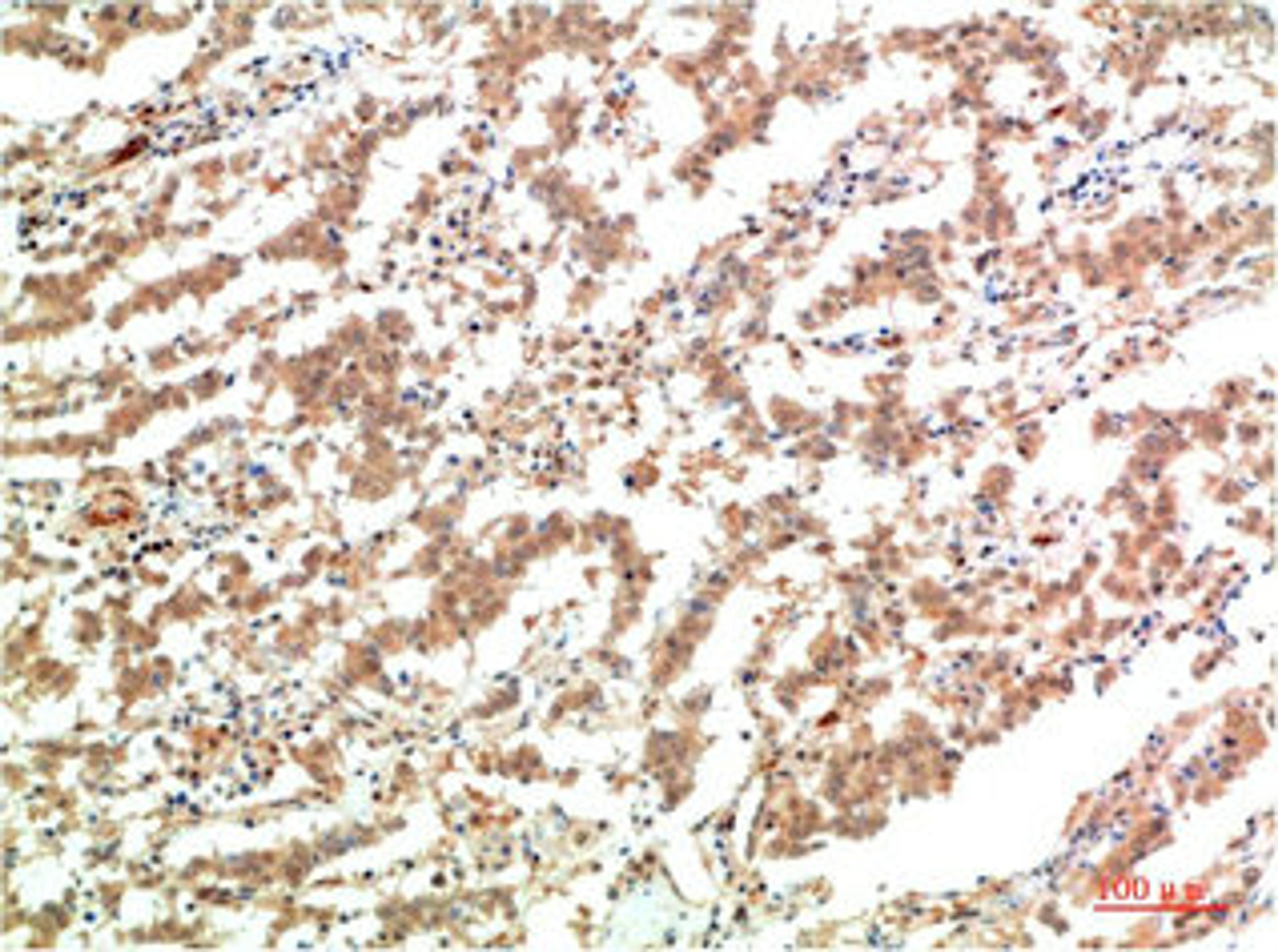 Immunohistochemical analysis of paraffin-embedded Human Lung Carcinoma Tissue using JAK2  Mouse mAb diluted at 1:200.
