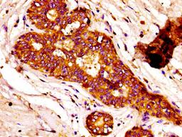 IHC image of CSB-PA13179A0Rb diluted at 1:100 and staining in paraffin-embedded human breast cancer performed on a Leica BondTM system. After dewaxing and hydration, antigen retrieval was mediated by high pressure in a citrate buffer (pH 6.0). Section was blocked with 10% normal goat serum 30min at RT. Then primary antibody (1% BSA) was incubated at 4&deg;C overnight. The primary is detected by a biotinylated secondary antibody and visualized using an HRP conjugated SP system.