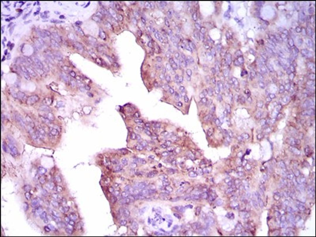 Immunohistochemistry: CaMKIV Antibody (8C5B8) [NBP2-37428] - Immunohistochemical analysis of paraffin-embedded rectum cancer tissues using CAMK4 mouse mAb with DAB staining.