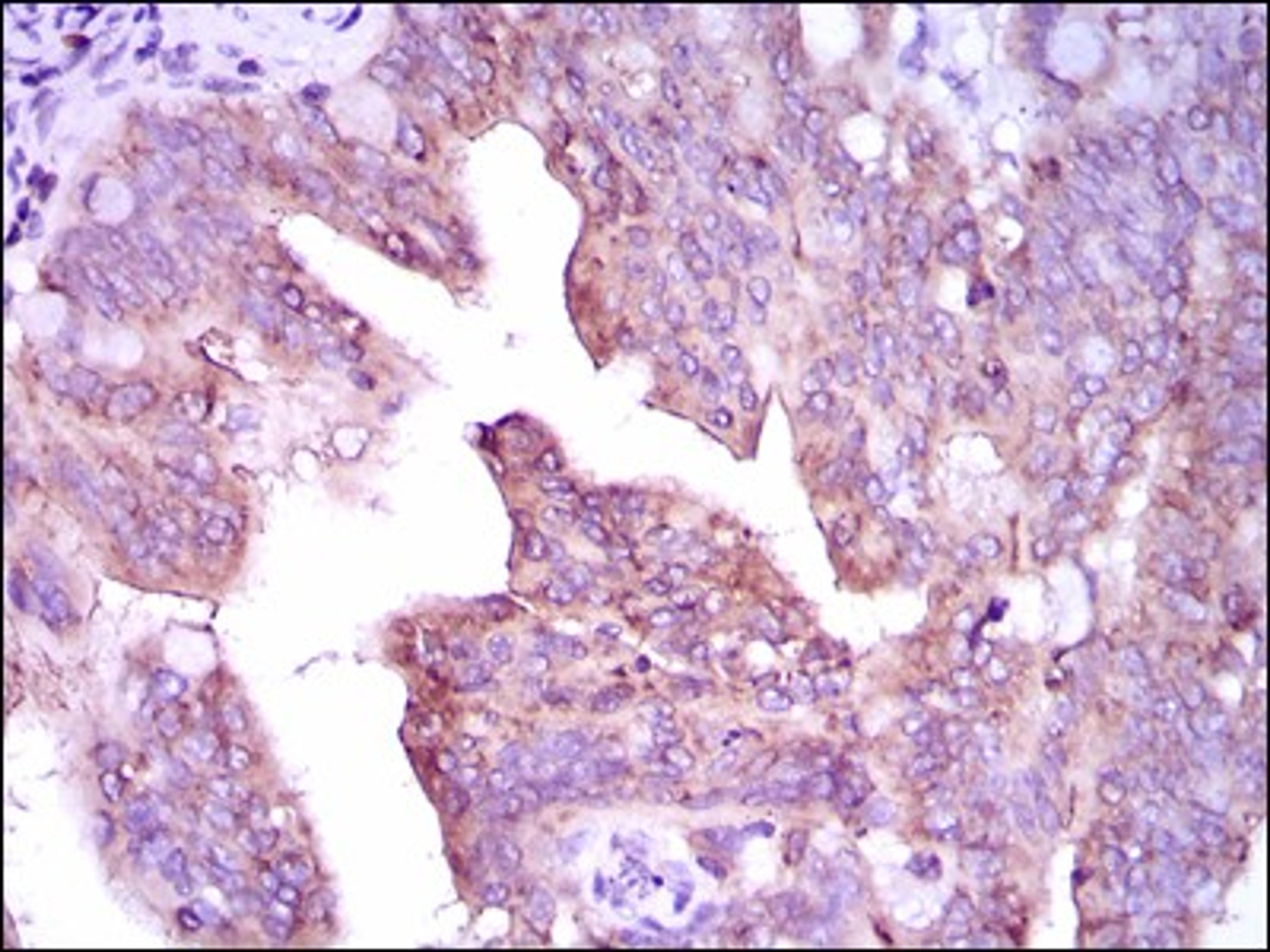 Immunohistochemistry: CaMKIV Antibody (8C5B8) [NBP2-37428] - Immunohistochemical analysis of paraffin-embedded rectum cancer tissues using CAMK4 mouse mAb with DAB staining.