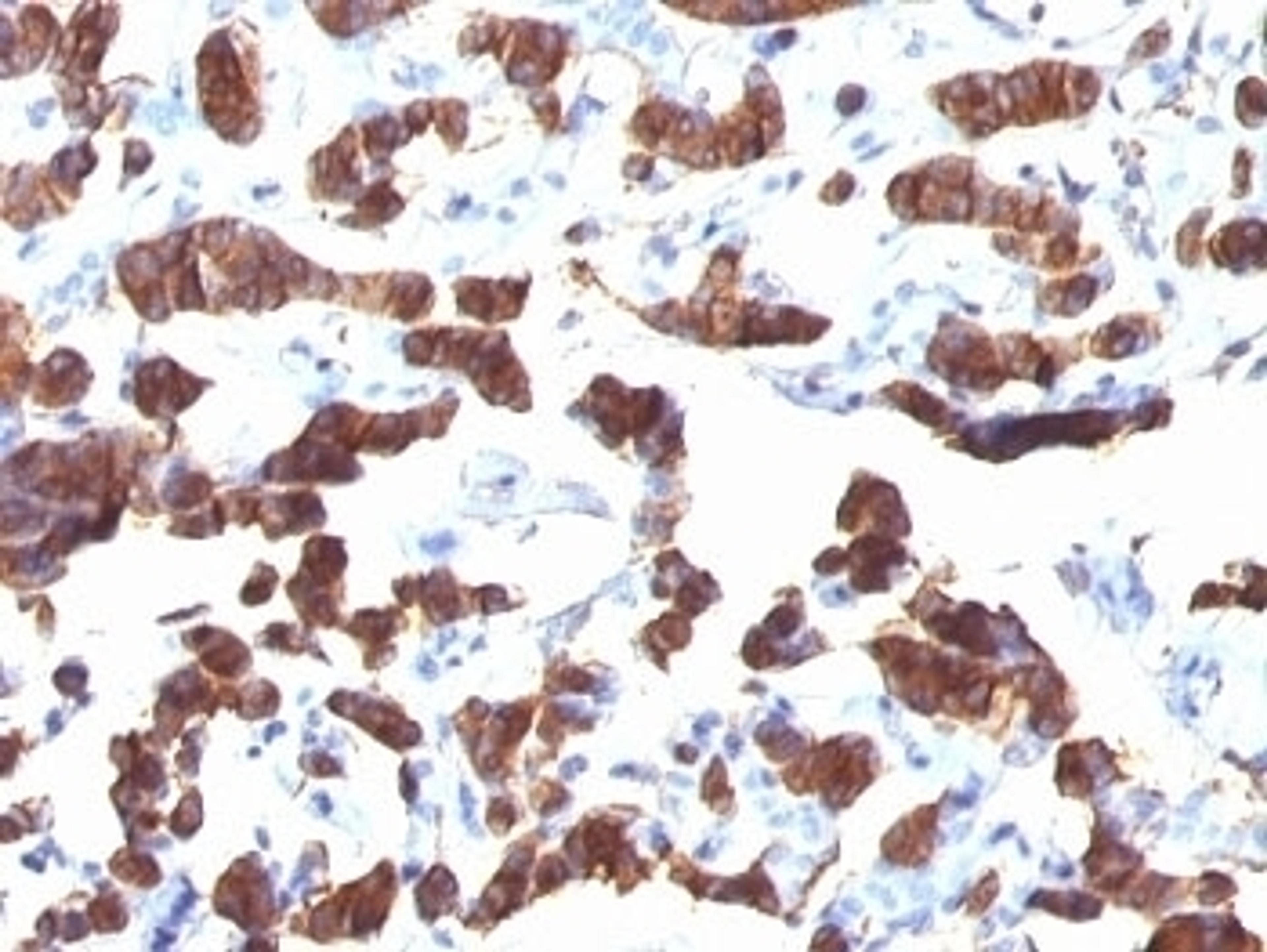 Formalin-fixed, paraffin-embedded human thyroid carcinoma stained with TG antibody (TGB24).