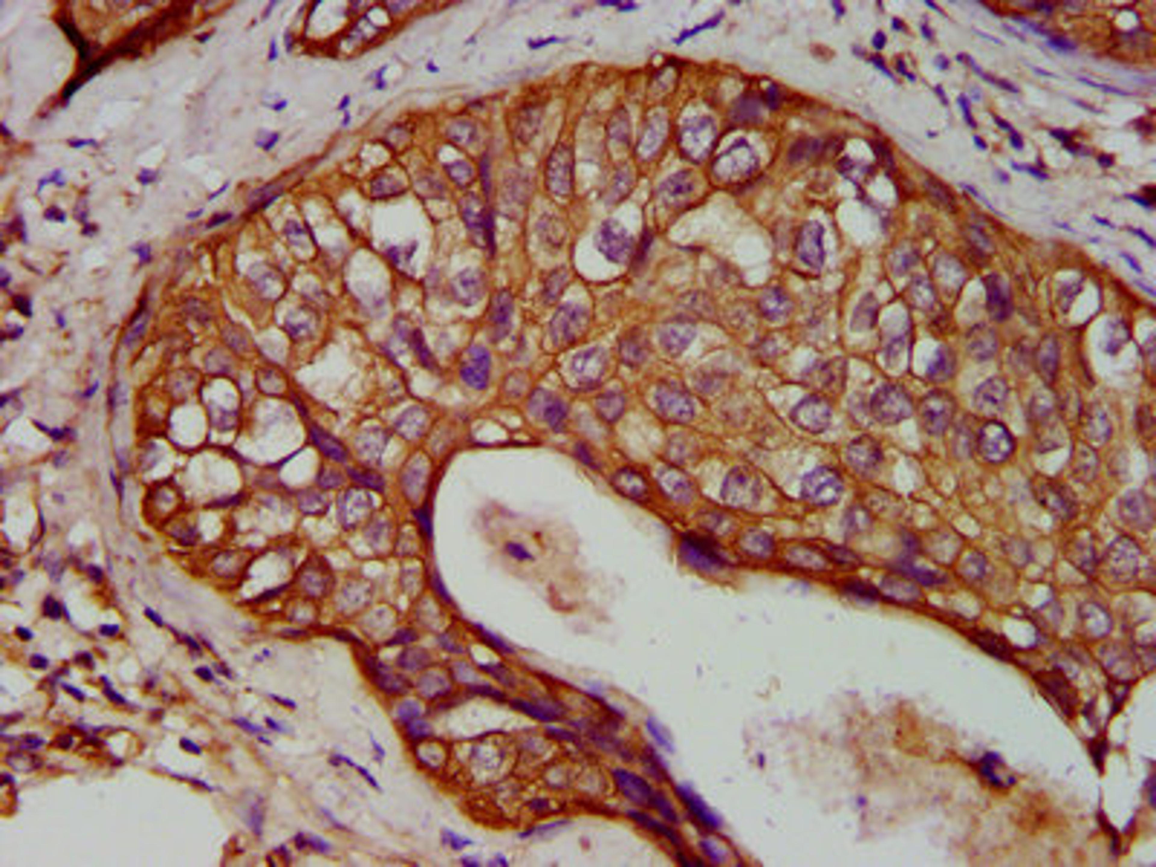 IHC image of CSB-PA012503LA01HU diluted at 1:400 and staining in paraffin-embedded human cervical cancer performed on a Leica BondTM system. After dewaxing and hydration, antigen retrieval was mediated by high pressure in a citrate buffer (pH 6.0). Section was blocked with 10% normal goat serum 30min at RT. Then primary antibody (1% BSA) was incubated at 4°C overnight. The primary is detected by a biotinylated secondary antibody and visualized using an HRP conjugated SP system.