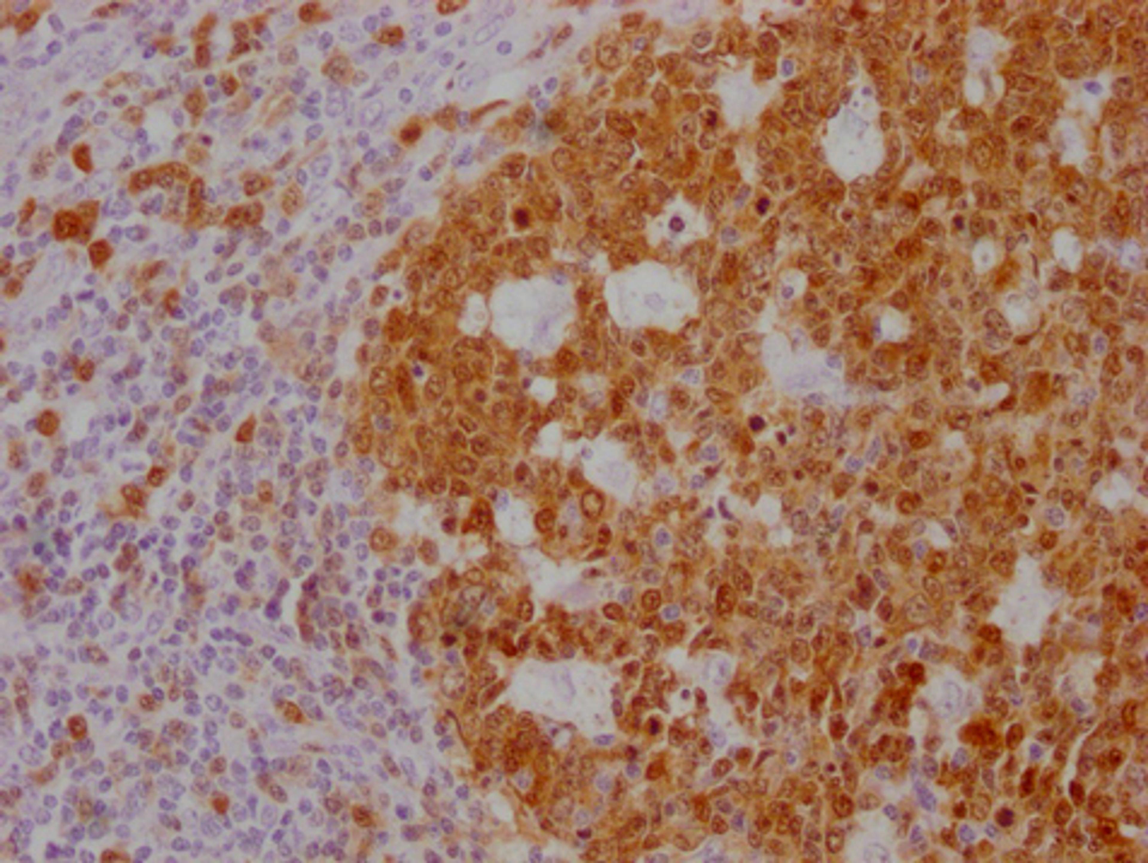 IHC image of CSB-MA181399 diluted at 1:100 and staining in paraffin-embedded human tonsil tissue performed on a Leica BondTM system. After dewaxing and hydration, antigen retrieval was mediated by high pressure in a citrate buffer (pH 6.0). Section was blocked with 10% normal goat serum 30min at RT. Then primary antibody (1% BSA) was incubated at 4°C overnight. The primary is detected by a Goat anti-mouse IgG polymer labeled by HRP and visualized using 0.05% DAB.
