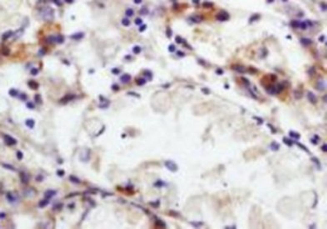 Immunohistochemical analysis of formalin-fixed paraffin embedded human gastric carcinoma tissue using CEACAM8 antibody (dilution at 1:200)