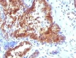 Formalin-fixed, paraffin-embedded human prostate carcinoma stained with Prostate Specific antibody (KLK3/1248).