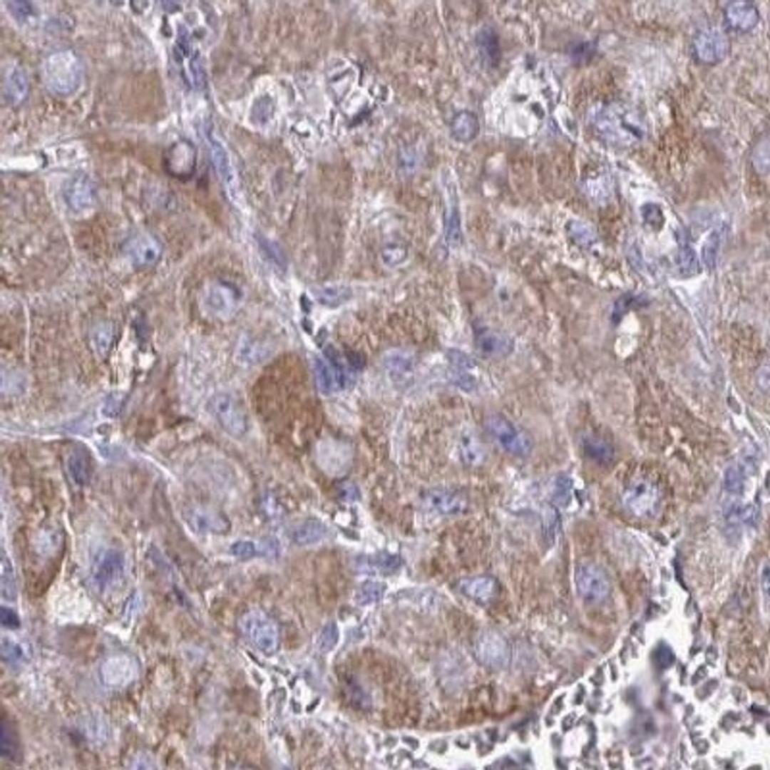 Immunohistochemistry: ZNF362 Antibody [NBP2-31756] - liver cancer