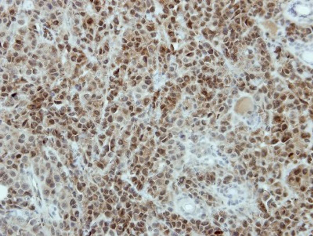 Immunohistochemistry-Paraffin: TRA2B Antibody [NBP2-15143] - Paraffin-embedded HBL435 xenograft, using antibody at 1:500 dilution.