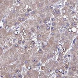 Immunohistochemistry: AGTPBP1 Antibody [NBP2-31662] - liver cancer