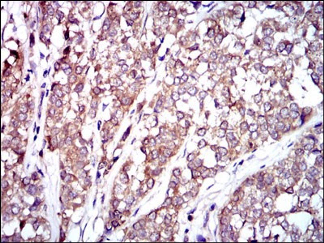 Immunohistochemistry: Raf-1 Antibody (4G4) [NBP2-37513] - Immunohistochemical analysis of paraffin-embedded bladder cancer tissues using RAF1 mouse mAb with DAB staining.