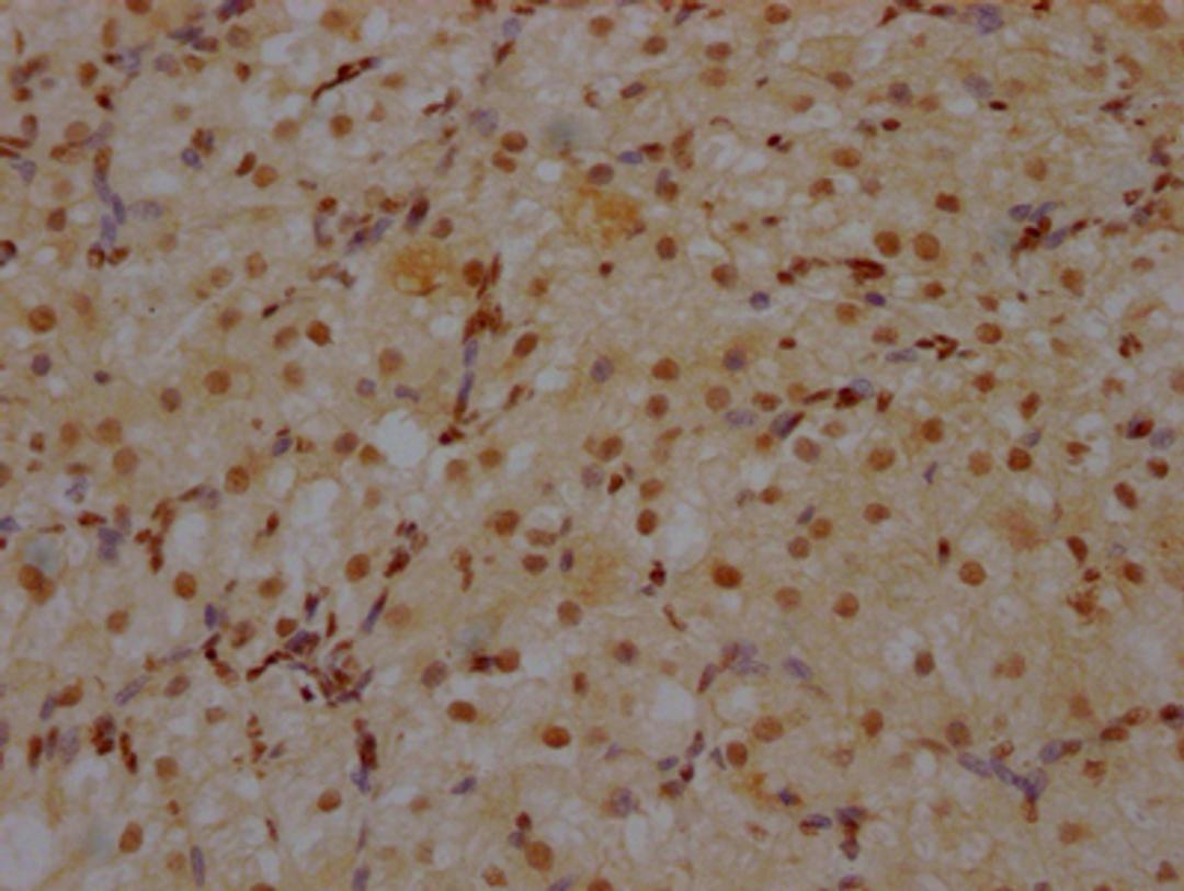 IHC image of CSB-RA930964A0HU diluted at 1:100 and staining in paraffin-embedded human ovarian tissue performed on a Leica BondTM system. After dewaxing and hydration, antigen retrieval was mediated by high pressure in a citrate buffer (pH 6.0). Section was blocked with 10% normal goat serum 30min at RT. Then primary antibody (1% BSA) was incubated at 4℃ overnight. The primary is detected by a Goat anti-rabbit IgG polymer labeled by HRP and visualized using 0.05% DAB.
