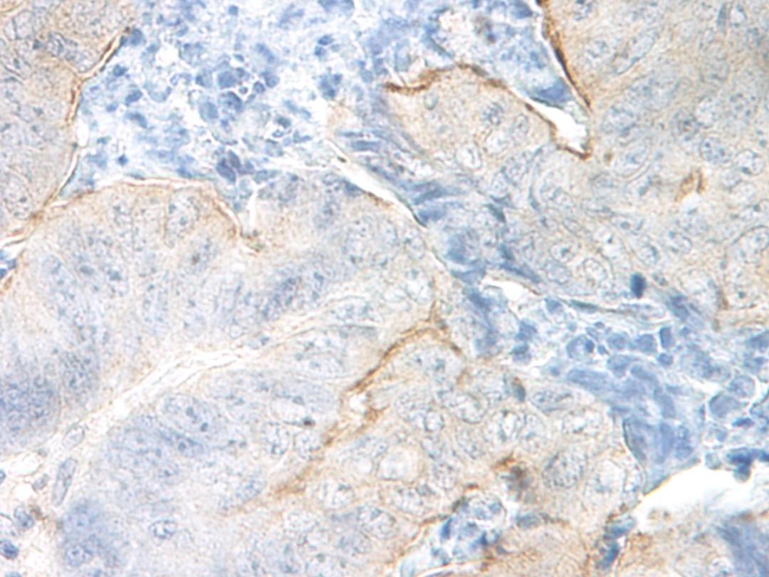 This antibody stained formalin-fixed, paraffin-embedded sections of human colon/rectum adenocarcinoma. The recommended concentration is 1.5 mg/ml with an overnight incubation at 4&#730;C. An HRP-labeled polymer detection system was used with a DAB chromog