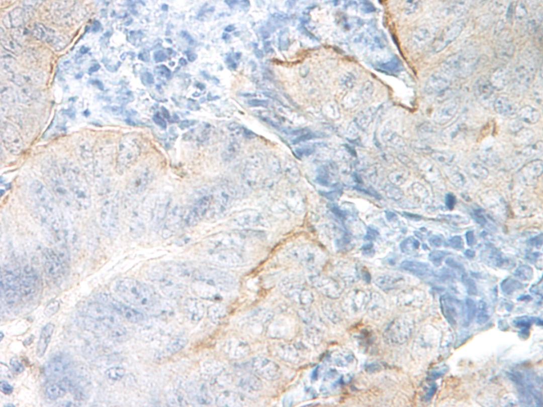 This antibody stained formalin-fixed, paraffin-embedded sections of human colon/rectum adenocarcinoma. The recommended concentration is 1.5 mg/ml with an overnight incubation at 4˚C. An HRP-labeled polymer detection system was used with a DAB chromog