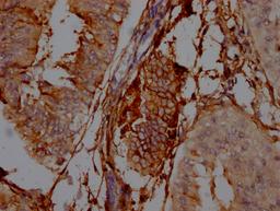 IHC image of CSB-RA978310A0HU diluted at 1:100 and staining in paraffin-embedded human endometrial cancer performed on a Leica BondTM system. After dewaxing and hydration, antigen retrieval was mediated by high pressure in a citrate buffer (pH 6.0). Section was blocked with 10% normal goat serum 30min at RT. Then primary antibody (1% BSA) was incubated at 4℃ overnight. The primary is detected by a Goat anti-rabbit IgG polymer labeled by HRP and visualized using 0.05% DAB.