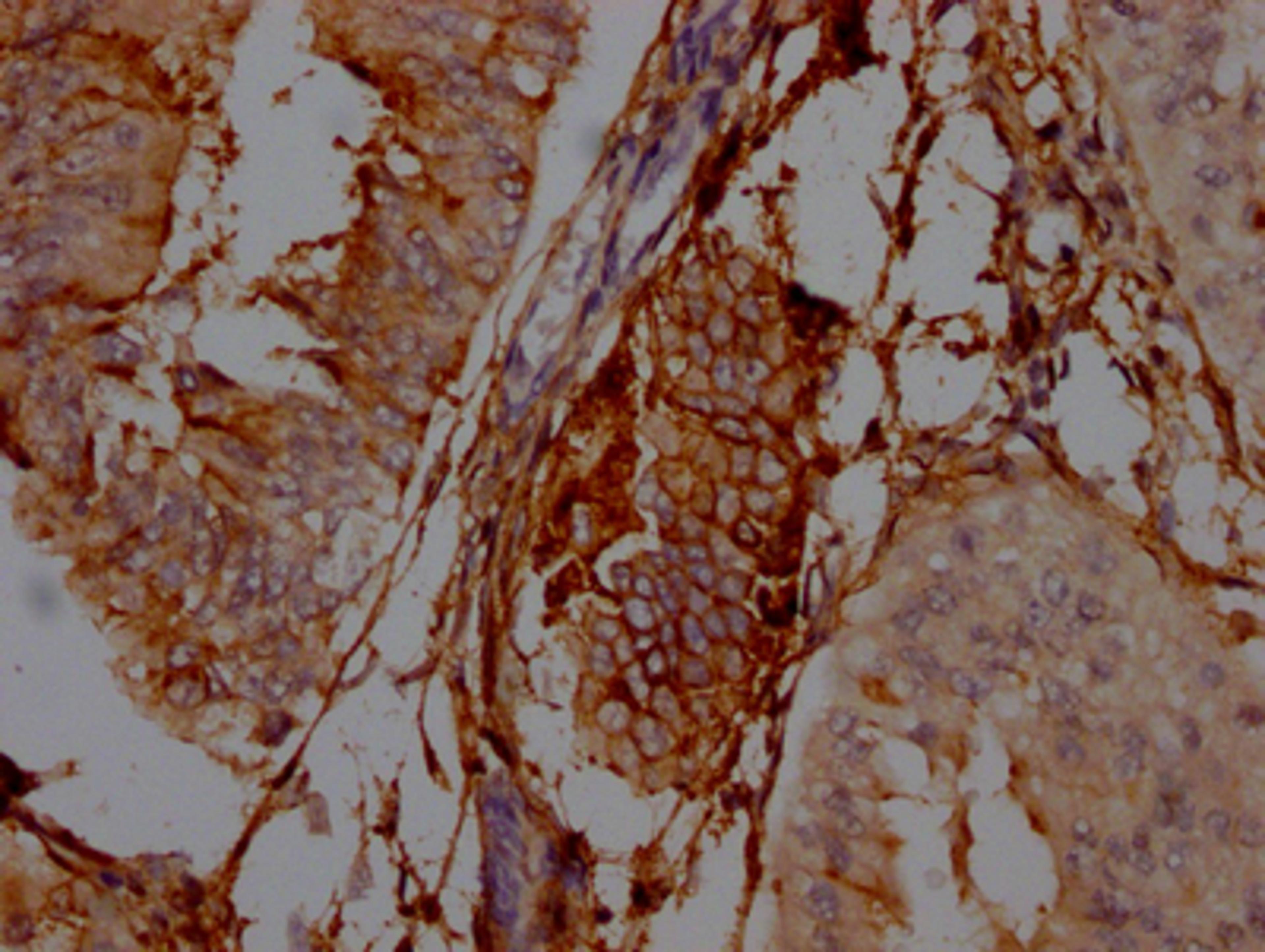 IHC image of CSB-RA978310A0HU diluted at 1:100 and staining in paraffin-embedded human endometrial cancer performed on a Leica BondTM system. After dewaxing and hydration, antigen retrieval was mediated by high pressure in a citrate buffer (pH 6.0). Section was blocked with 10% normal goat serum 30min at RT. Then primary antibody (1% BSA) was incubated at 4℃ overnight. The primary is detected by a Goat anti-rabbit IgG polymer labeled by HRP and visualized using 0.05% DAB.