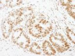 Immunohistochemistry-Paraffin: FOXK1 Antibody [NB100-88146] - FFPE section of human colon carcinoma.  Affinity purified rabbit anti-FOXK1 used at a dilution of 1:500.